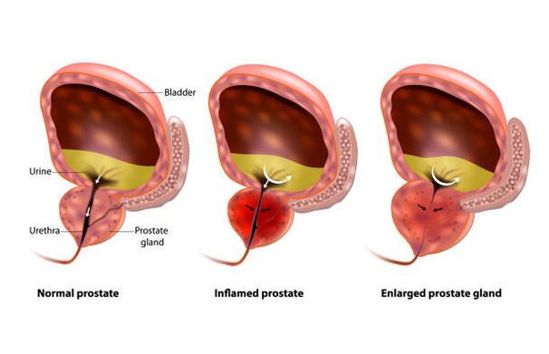 prostatitis is inflammation of the prostate gland